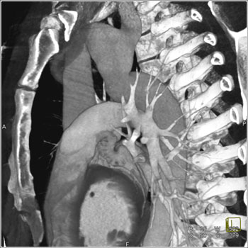 cardiac 64 mdct