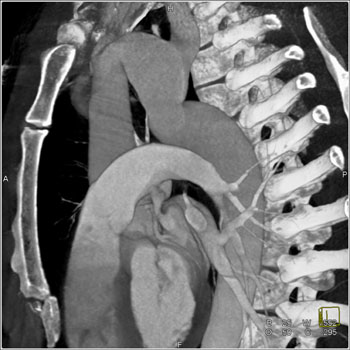 cardiac 64 mdct