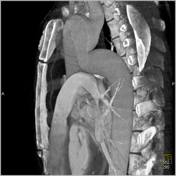 cardiac 64 mdct