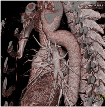 cardiac 64 mdct