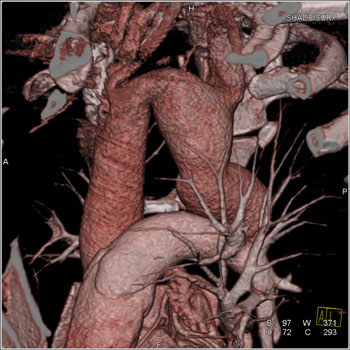 cardiac 64 mdct