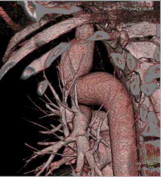 cardiac 64 mdct