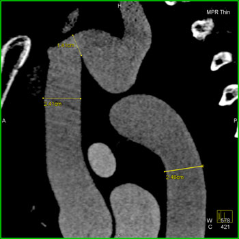 cardiac 64 mdct