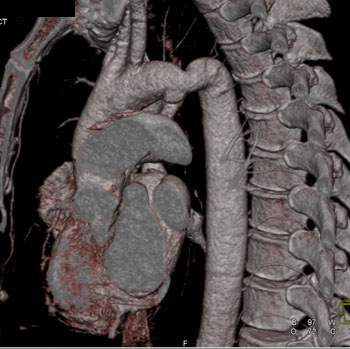 cardiac 64 mdct