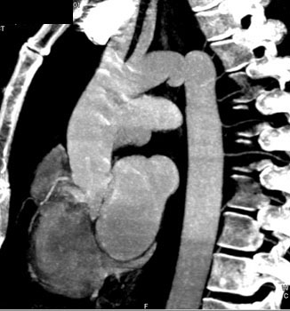 cardiac 64 mdct