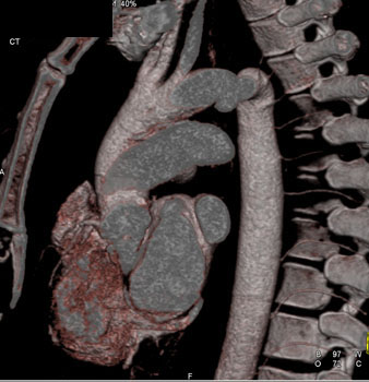 cardiac 64 mdct