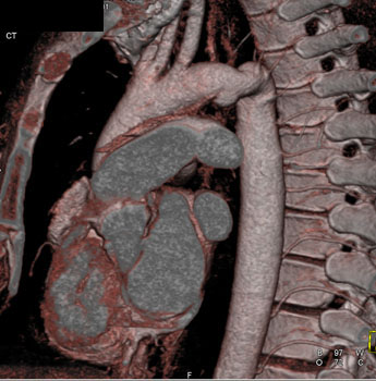 cardiac 64 mdct