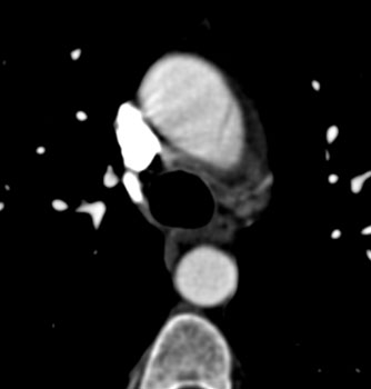 cardiac 64 mdct