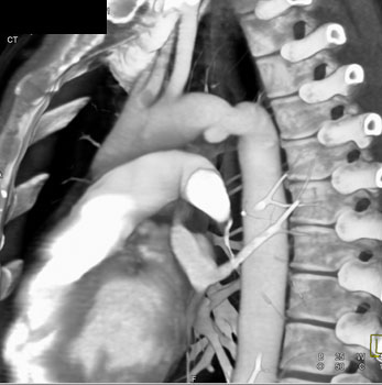 cardiac 64 mdct