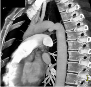 cardiac 64 mdct