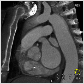 cardiac 64 mdct