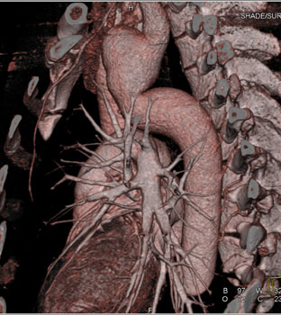 cardiac 64 mdct