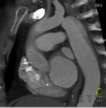 cardiac 64 mdct