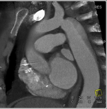 cardiac 64 mdct