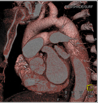 cardiac 64 mdct