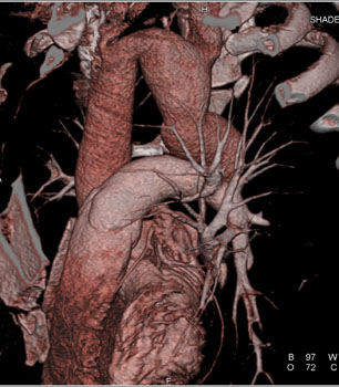 cardiac 64 mdct