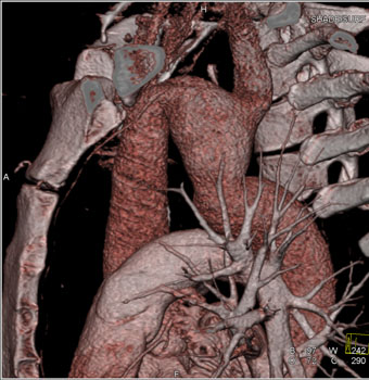 cardiac 64 mdct