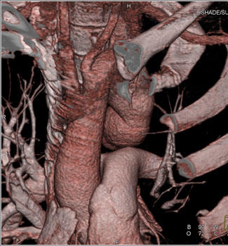 cardiac 64 mdct