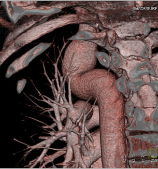 cardiac 64 mdct