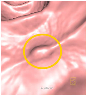 IV contrast image <td align=