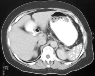 MDCT of the Spleen - CTisus.com CT Scanning
