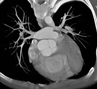 Normal aortic valve - diastole