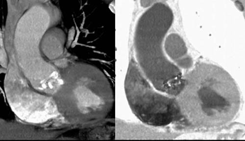 Calcified bicuspid aortic valve.