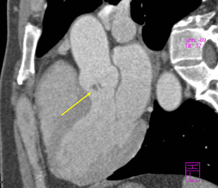 Thickened aortic valve leaflet 