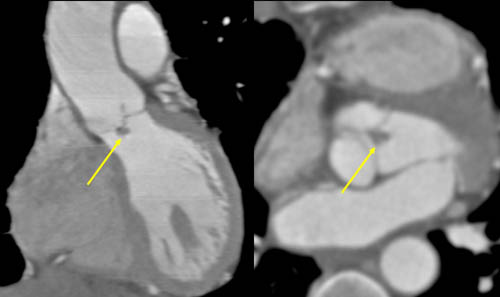 Vegetation on aortic valve 