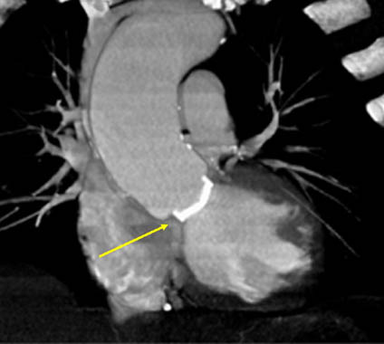 Mechanical aortic valve 