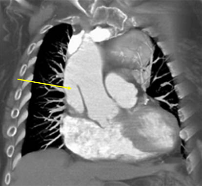 Type A dissection sparing the aortic root and coronary ostia. 