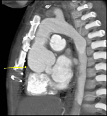 Aneurysmal dilatation aortic root. 