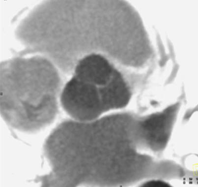 Normal aortic valve - diastole