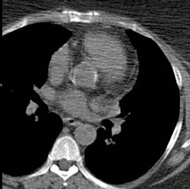 Aortic root calcification. 