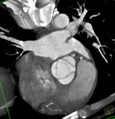 Normal aortic valve - systole