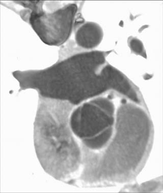 Normal aortic valve - systole