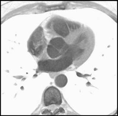 Bicuspid aortic valve - diastole