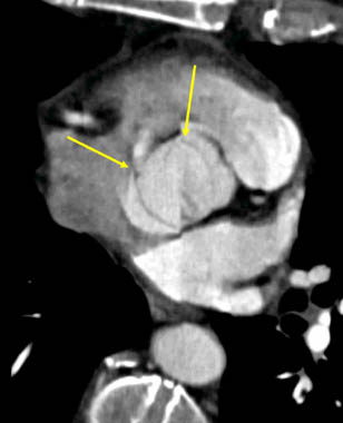 Bicuspid aortic valve - systole