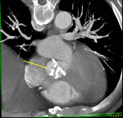 Calcified bicuspid aortic valve