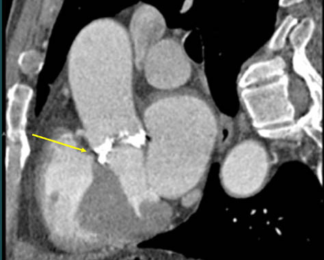 Calcified bicuspid aortic valve.