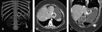 Gastric