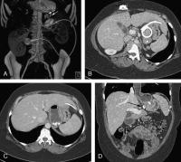 Gastric