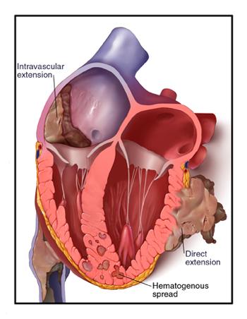 Heart metastasis
