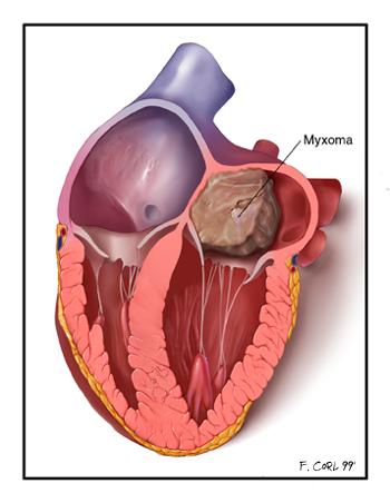 Heart myxoma