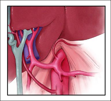 Accessory Right Hepatic Artery