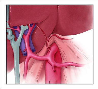 Accessory Left Hepatic Artery