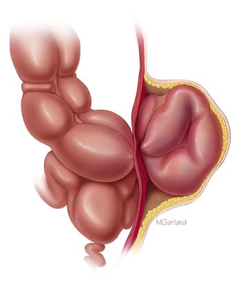 Large bowel hernia