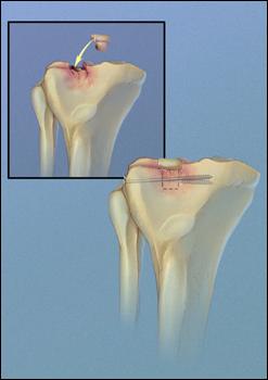 Type 3 Fracture Repair (Bone graft & lateral screw)