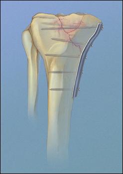 Type 4 Fracture Repair (Medial buttress plate & screws)