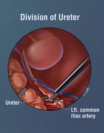 Division of ureter